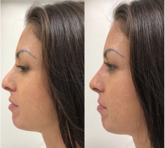 rhinoplastie lille